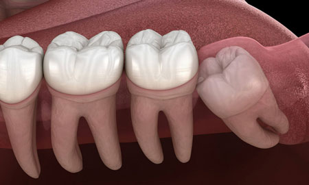 Wisdom tooth removal near me at Gachibowli