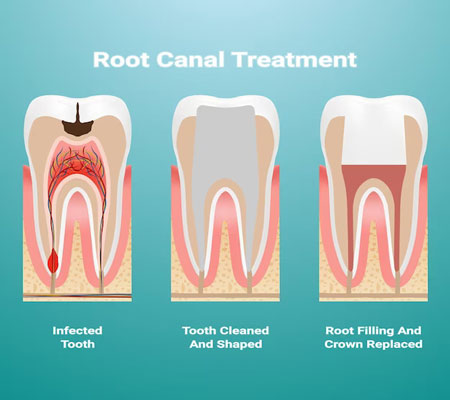 Root Canal Treatment Near me at Gachibowli