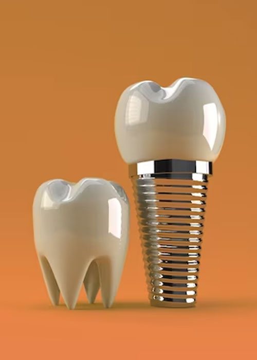 Dental Implants Near me at Gachibowli