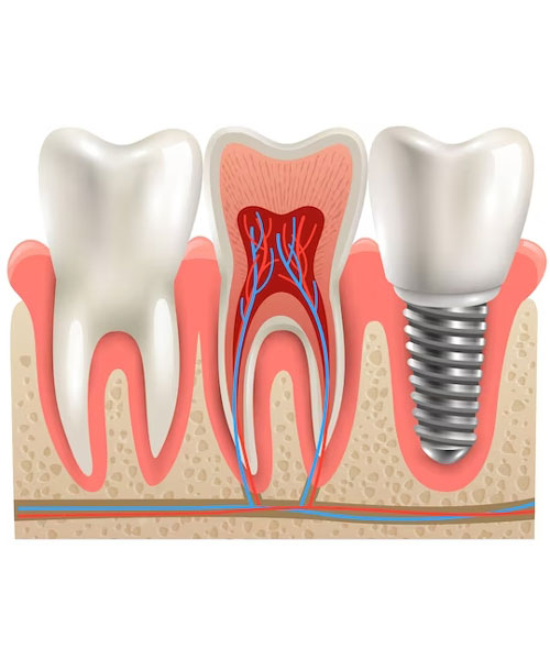 Dental Implants Near me at Gachibowli