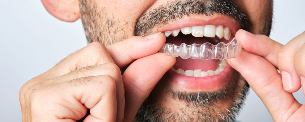 Invisalign in Gachibowli Hyderabad