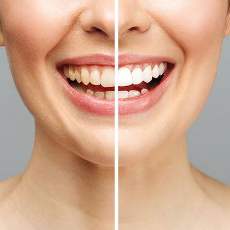 Teeth Whitening Near me at Gachibowli