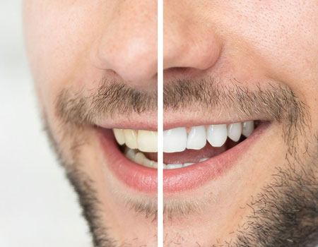 Teeth Whitening Near me at Gachibowli