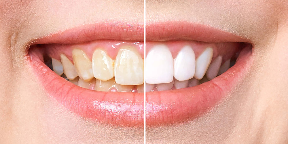 Teeth Whitening Near me at Gachibowli