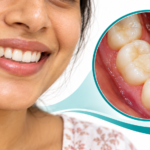 composite teeth filling
