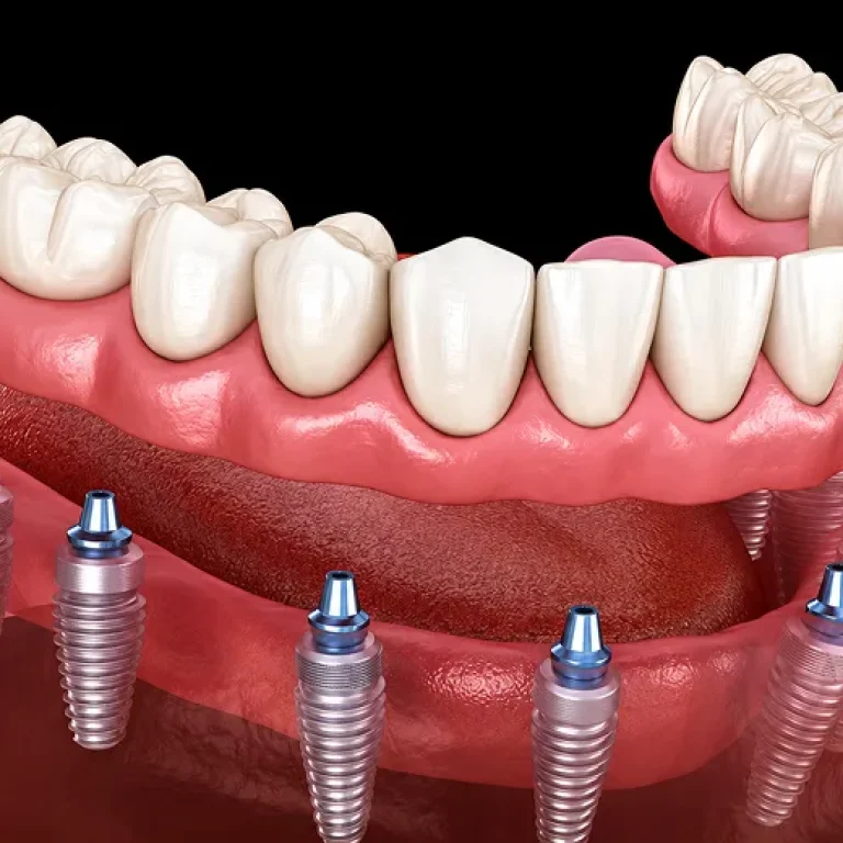 Full Mouth Rehabilitation image 01