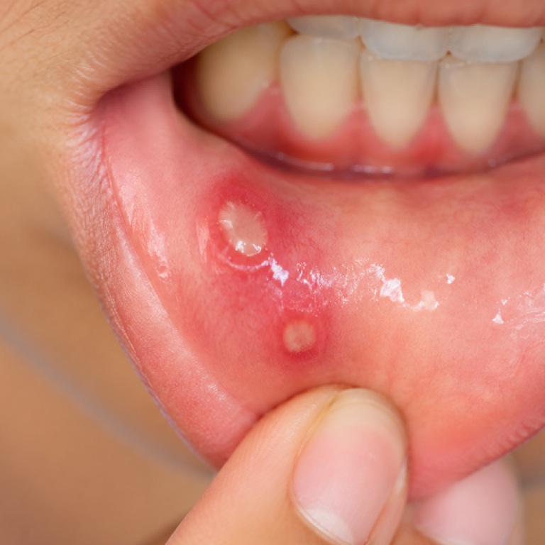 Mouth Ulcers 01